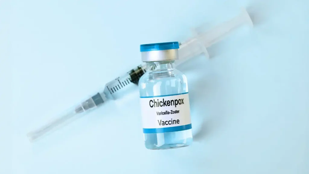 chickenpox